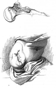 drawing of  de Gay’s wound and the shattered upper end of his thighbone 